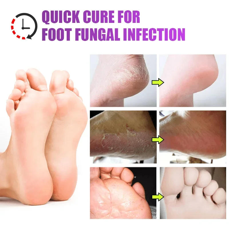 Description Picture 5 of item네일 Foot Care Tools KanyeHB Foot Ointment Feet Odor Care Cream Feet Skin Topical Cream Masajeador De Pies علاج الاسترخاء