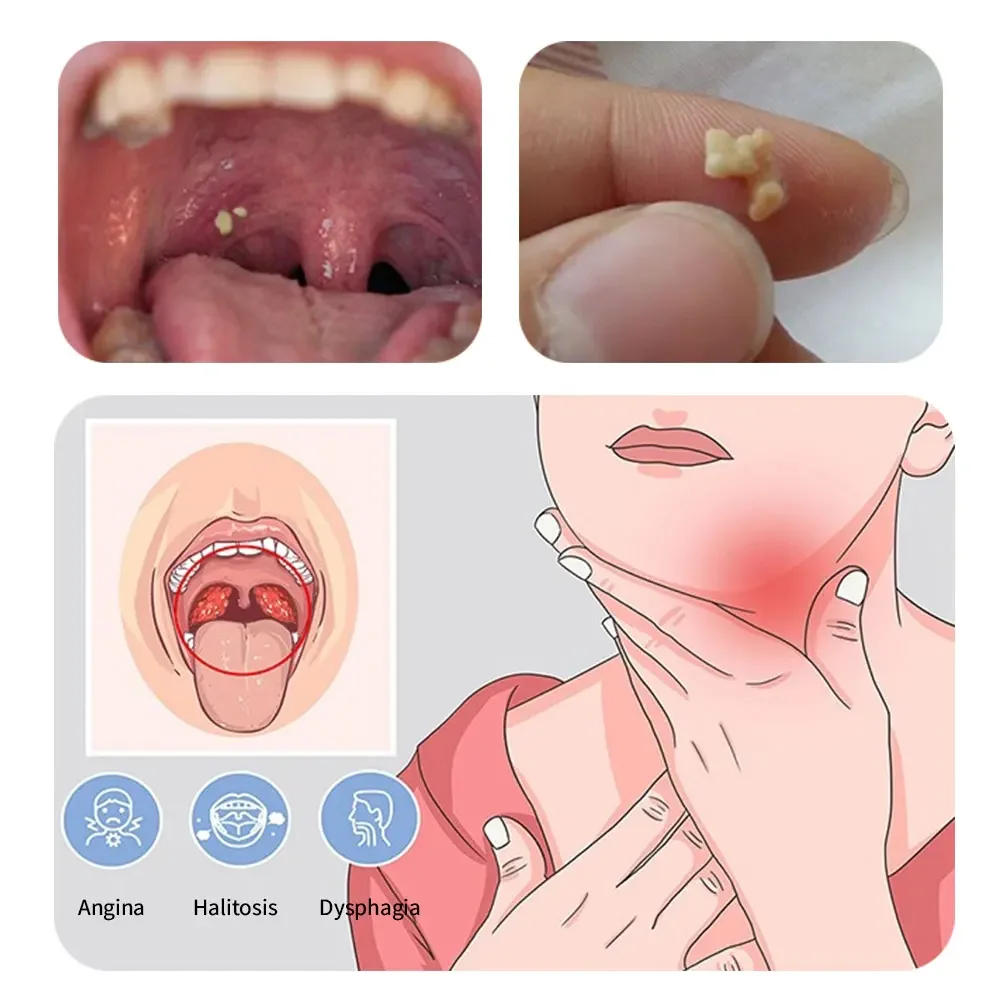 Description Picture 6 of itemLED Light Stainless Steel Remover Mouth Cleaning Care Tools Tonsil Stone Remover 1Pcs Ear Wax Tonsil Stone Remover Tool