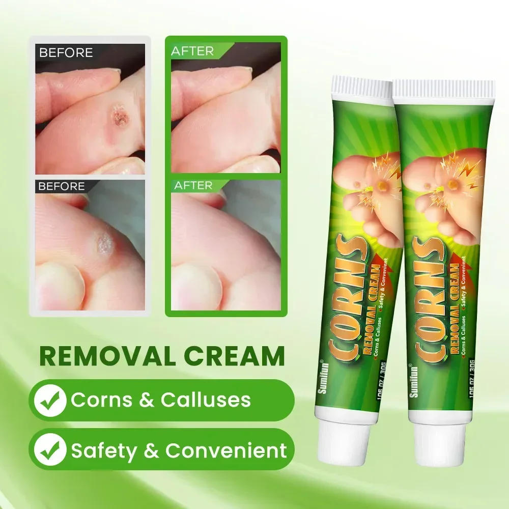Description Picture 5 of item30g Foot Corn Remover Cream Chicken Eye Skin Infection Treatment Ointment Feet Dead Skin Calluses Removal Tool Health Care