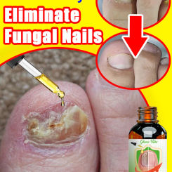 Eliminate Fungal Nails Permanently