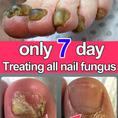 Nail fungus treatment essential oil, repair onychomycosis in 7 days