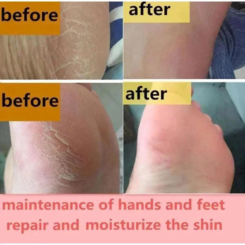 Description Picture 3 of item60% Urea Foot Cream Dry Cracked Feet Heel Gentle Exfoliation Softening Skin Ultra-Hydrating Hand Foot Care Cream Stick Protucts