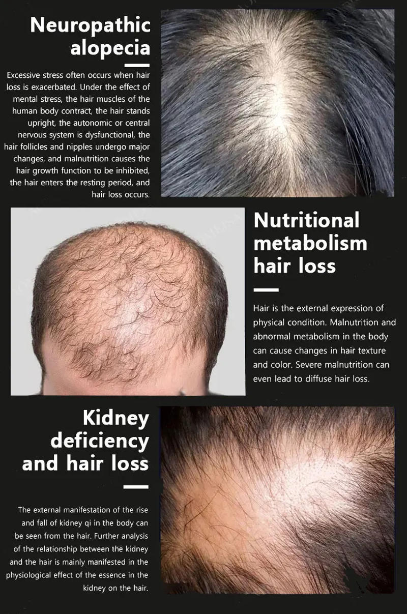 Description Picture 5 of itemFast Hair Growth Oil Baldness Repair Hereditary Hair Loss Postpartum Hair Loss Seborrheic Hair Loss Hair Oil Fast Hair Growth