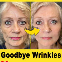 wrinkles disappeared，20 years younger, no fine lines
