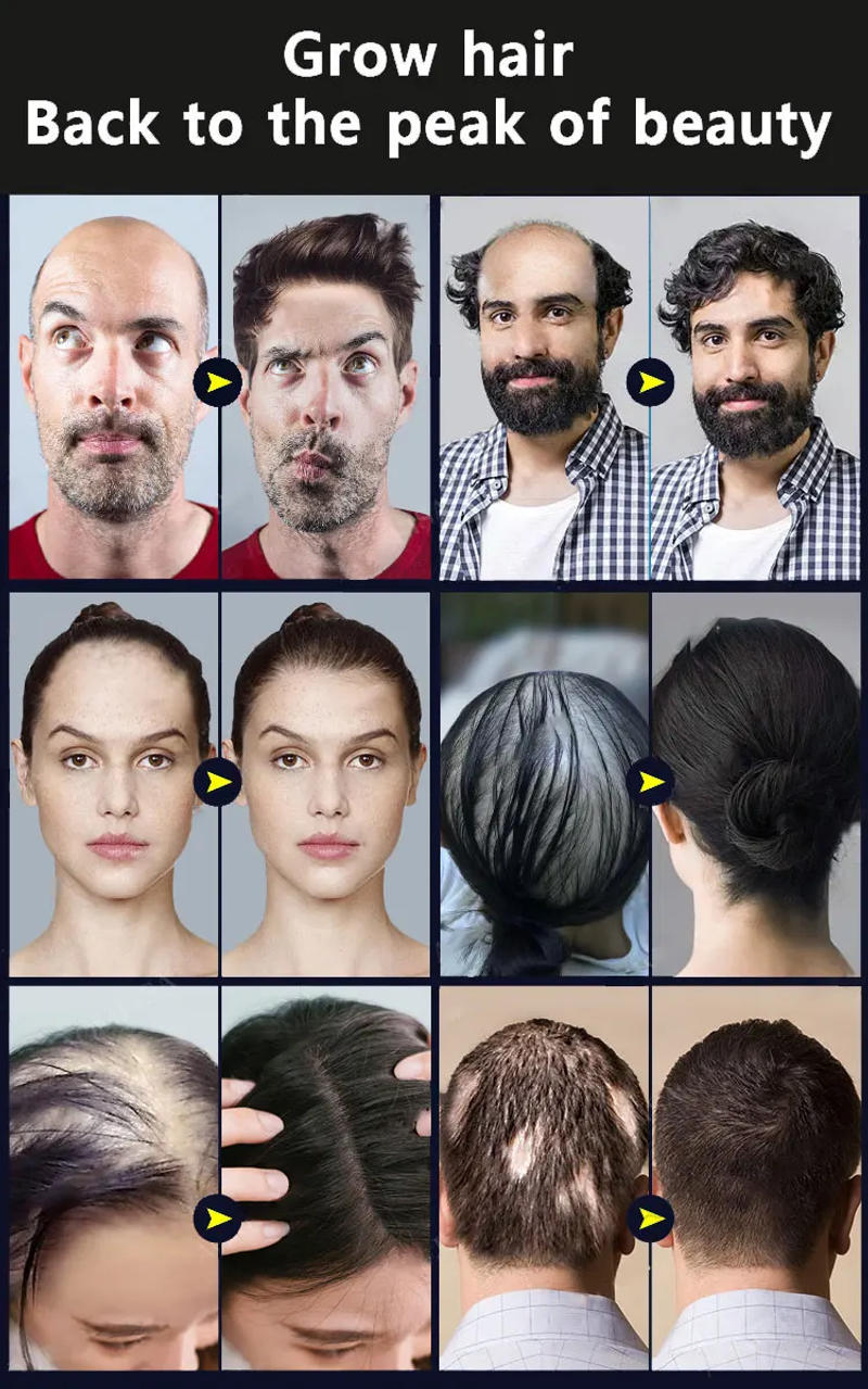 Description Picture 3 of itemFast Hair Growth Oil Baldness Repair Hereditary Hair Loss Postpartum Hair Loss Seborrheic Hair Loss Hair Oil Fast Hair Growth