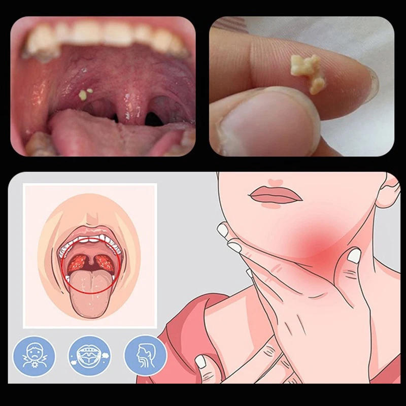 Description Picture 4 of item1Pcs Ear Wax Tonsil Stone Remover Tool LED Light Stainless Steel Remover Mouth Cleaning Care Tools Tonsil Stone Remover