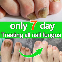 Nail fungus treatment essential oil, repair onychomycosis in 7 days