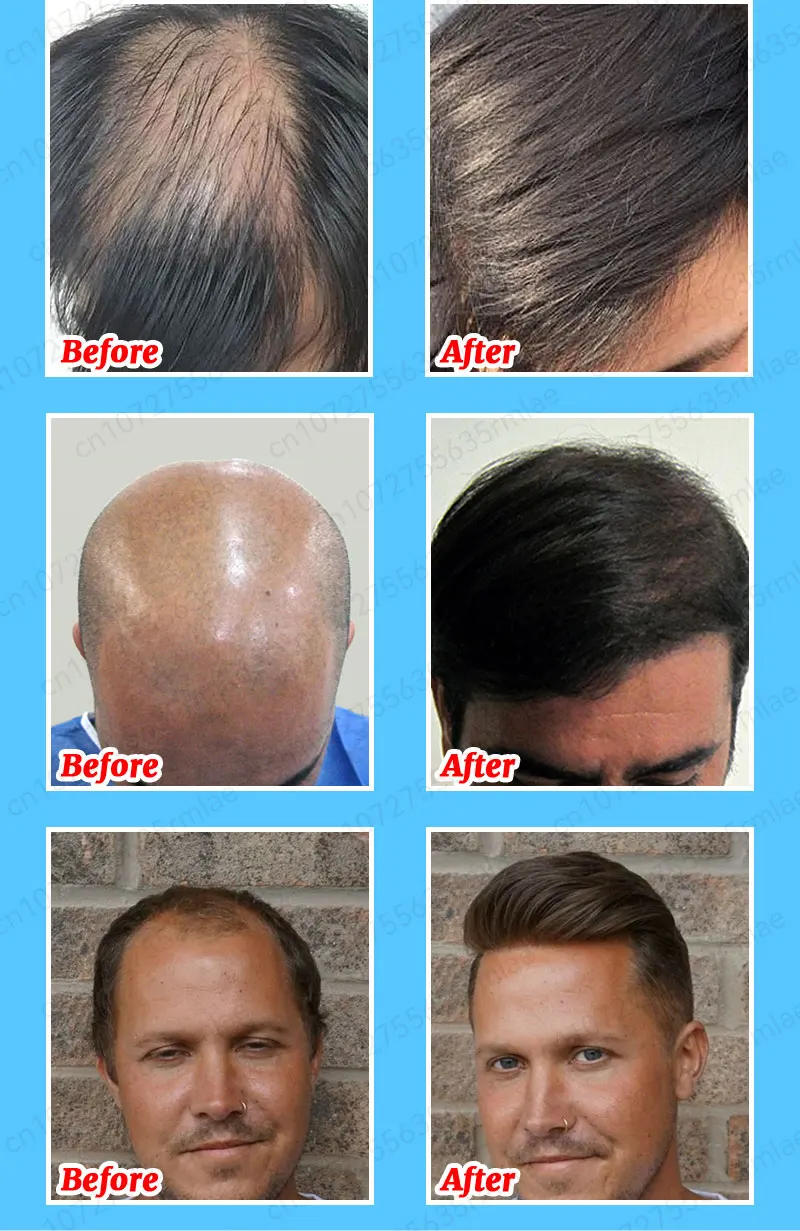 Description Picture 5 of itemHair growth solution can quickly and effectively grow hair, repair hereditary hair loss, postpartum hair loss, and seborrheic al