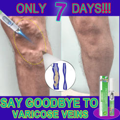 Say goodbye to varicose veins