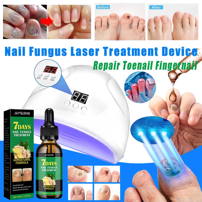 Description Picture 3 of itemNail Fungus Laser Treatment Device Repair Removes Toenail Fingernail Treatment Onychomycosis with Mushrooms Foot Care Tool