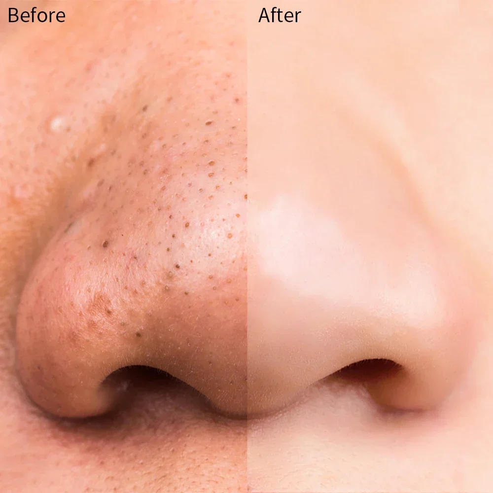 Description Picture 5 of itemDeep Cleansing Blackhead Remove Nose Strips for Acne Blackhead Removal Shrink Pore Unisex Nose Blackhead Sticker Patch Skin Care