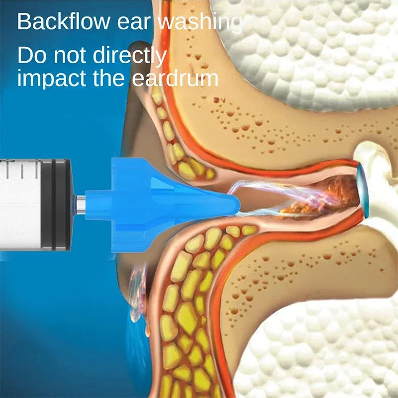 Description Picture 5 of item2Pcs Ear Cleaner Irrigation Kit Ear Wax Removal Tool Water Washing Syringe Comfortable Unique 10ML Health Care