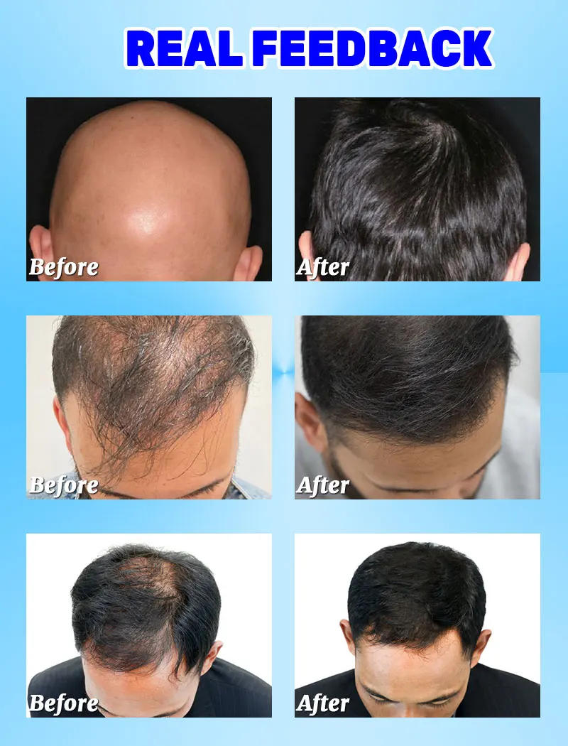 Description Picture 3 of itemHair growth solution can quickly and effectively grow hair, repair hereditary hair loss, postpartum hair loss, and seborrheic al