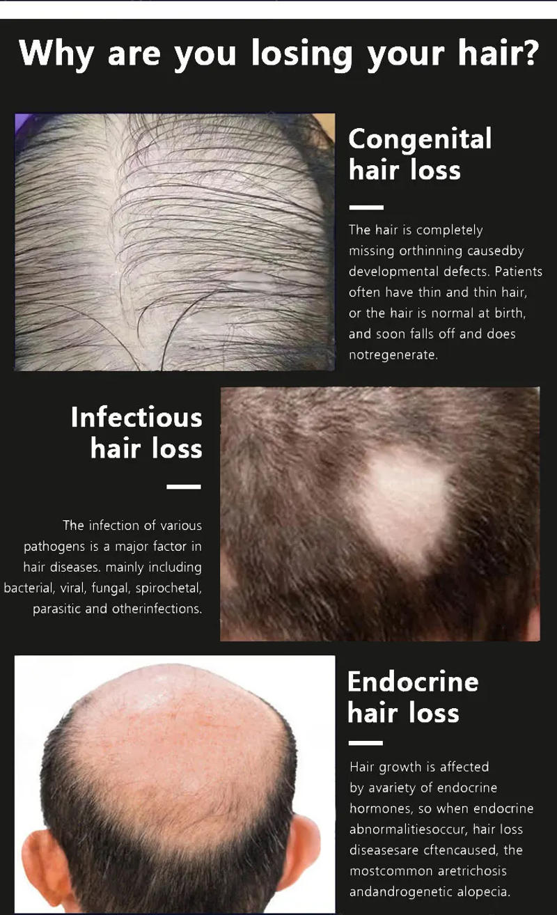 Description Picture 4 of itemFast Hair Growth Oil Baldness Repair Hereditary Hair Loss Postpartum Hair Loss Seborrheic Hair Loss Hair Oil Fast Hair Growth