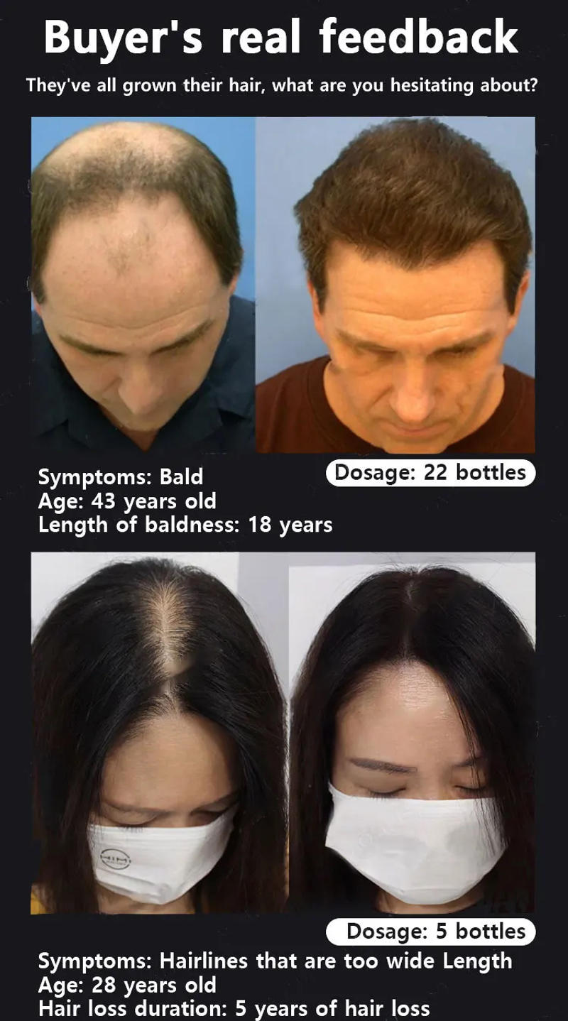 Description Picture 6 of itemFast Hair Growth Oil Baldness Repair Hereditary Hair Loss Postpartum Hair Loss Seborrheic Hair Loss Hair Oil Fast Hair Growth