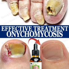 Eliminate nail problems