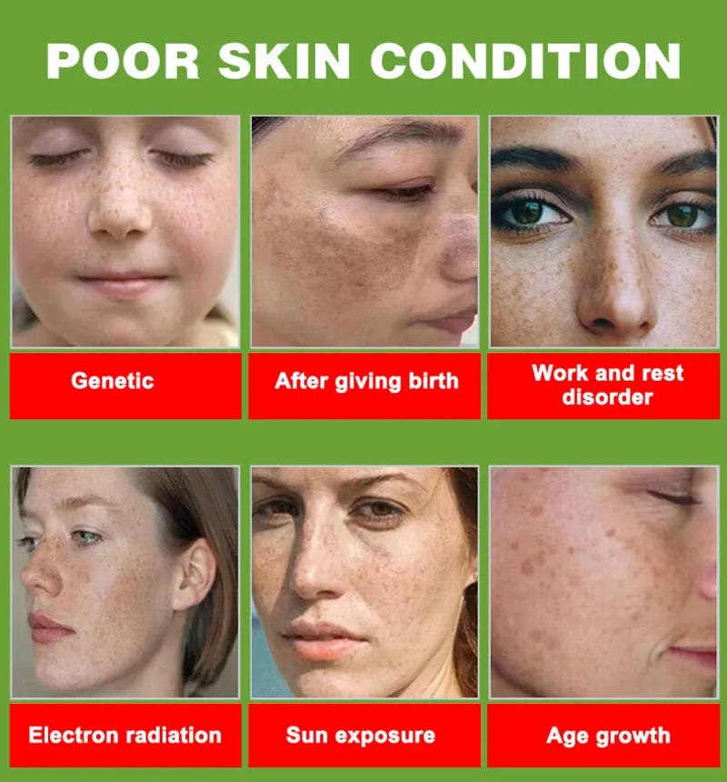Description Picture 4 of itemFreckles Removal Essence Remove Facial Spots Skin Dark Spot Remove Melasma Spots Sunspots Whitening And Freckle Removing oil