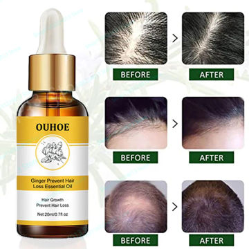 Ginger Hair Growth Product Anti-loss Hair Regrowth Serum Oil Fast Grow Prevent Baldness Treatment Alopecia Men Women Hair Care