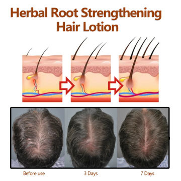 Sdotter 100ml Eelhoe Herbal Root Dense Hair Lotion Hair Fixing Thick Hairline Repair Hair Care Moisturizing Hairs Anti-Fall Supp