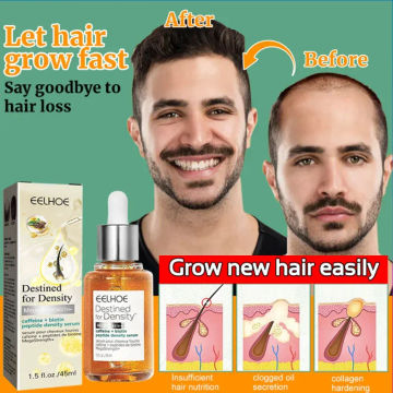 Sdottor New Fast Hair Growth Products Hair Thinning Baldness Treatment Seborrheic Alopecia Hairline Upward Postpartum Hair Loss