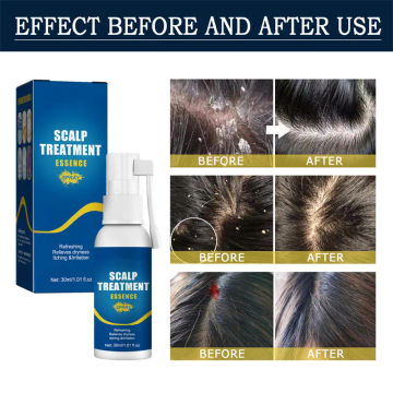 Hair Scalp Treatment Essence Spray Anti-Dandruff Smoothing Soft Repair Dry Frizz Greasy Hair Care for Men Women