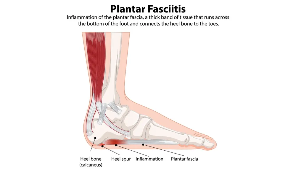 Plantar fasciitis remedy in ayurveda deals