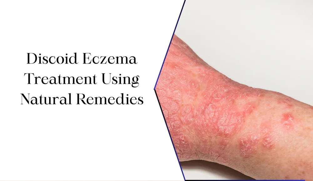 Discooid Rash Discoid Eczema Treatment Using Natural Remedies | All-Cures