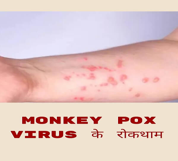 Monkeypox virus - are the alarm bells coming again in hindi