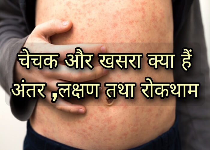 What are Chickenpox and Measles, the difference, symptoms, spread, treatment and prevention in hindi