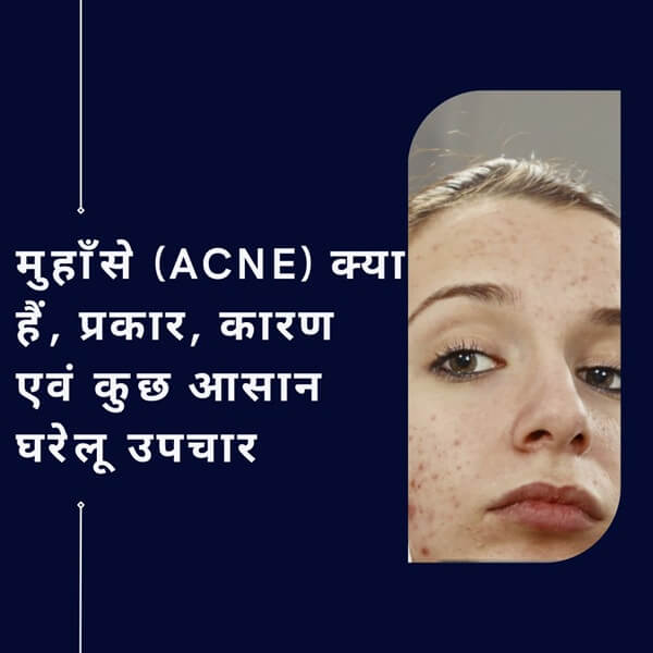 Acne types causes and some easy home remedies