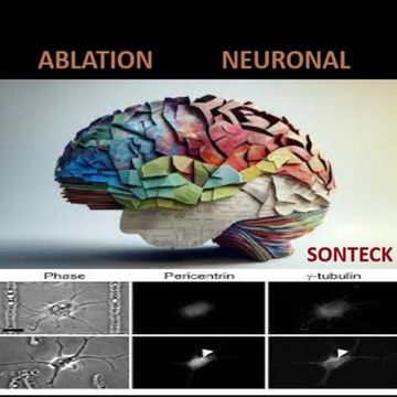 Ablation neuronale