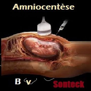 Amniocentèse