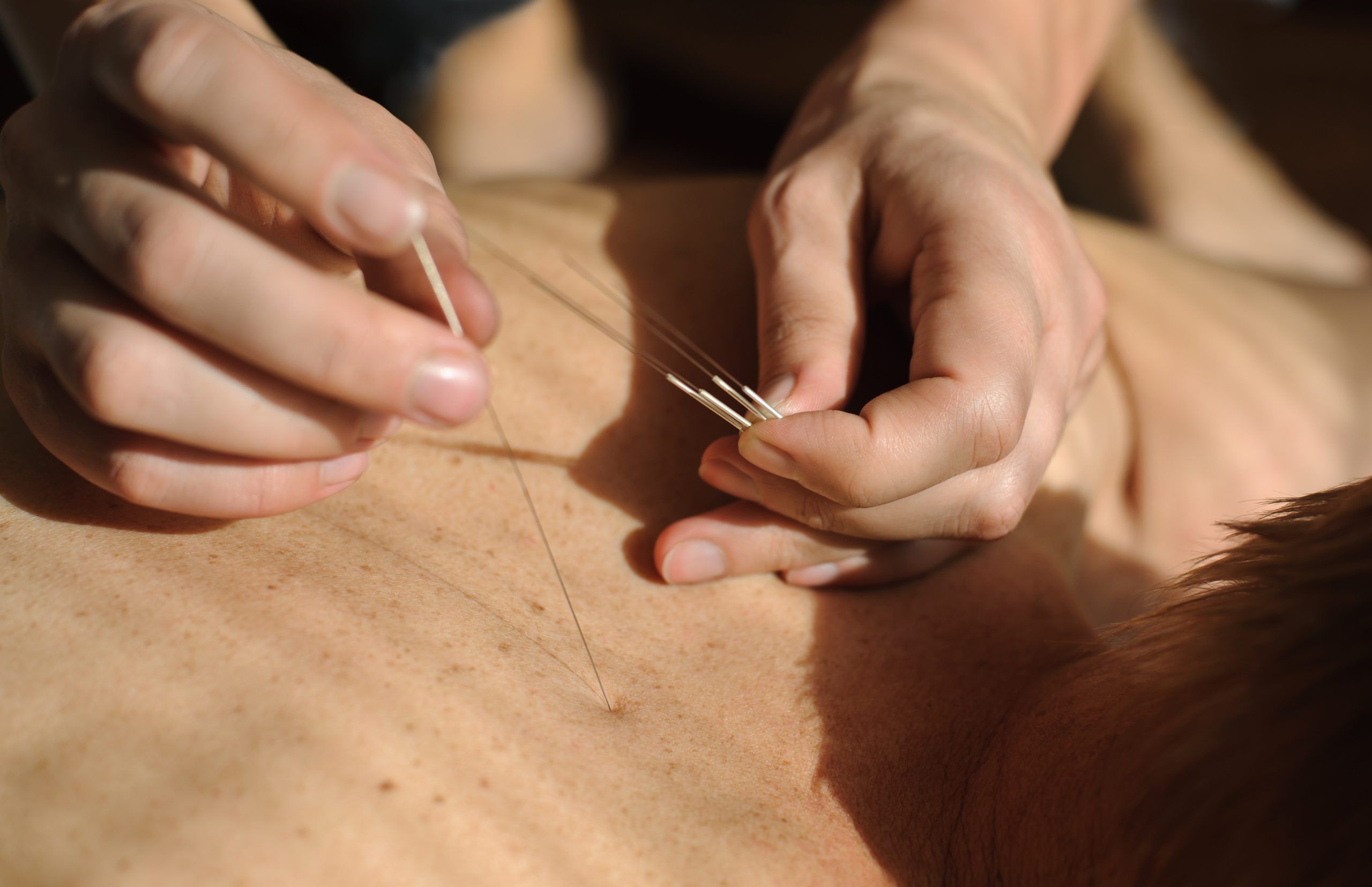 Manfaat Terapi Akupuntur Untuk Memperbesar Payudara Secara Alami