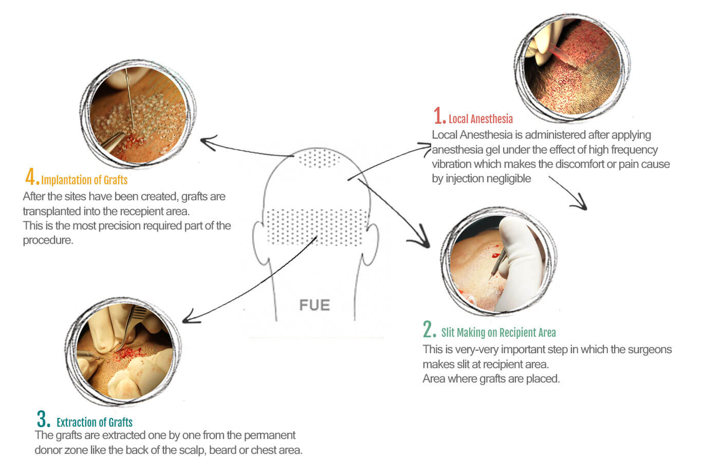 Fue Hair Transplant in Dubai, Abu Dhabi - infographic