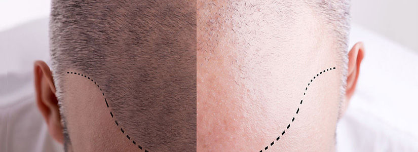 Acell-hair-loss-therapy