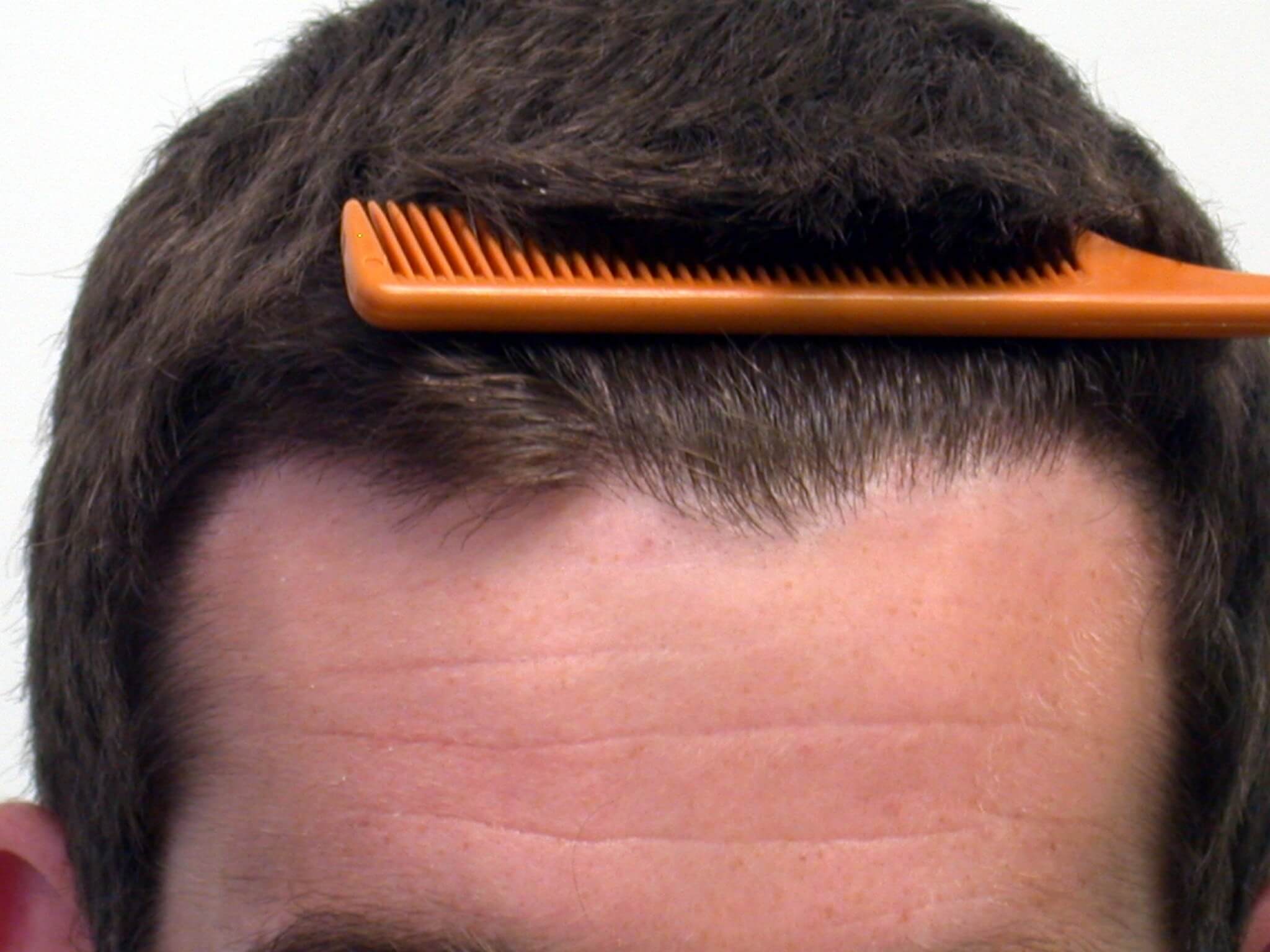 Pre And Post Operative Care For Acell Prp Hair Loss Treatment