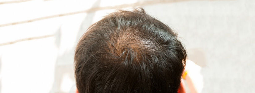 Crown Hair Transplant For A Thinning Scalp In Dubai Abu Dhabi