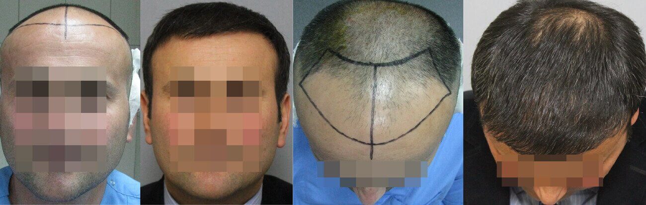 Does insurance cover hair transplant Idea