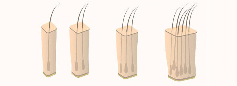 micrografting-hair-transplant