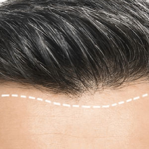 Hair Transplant Procedure in Dubai Abu Dhabi Hair 