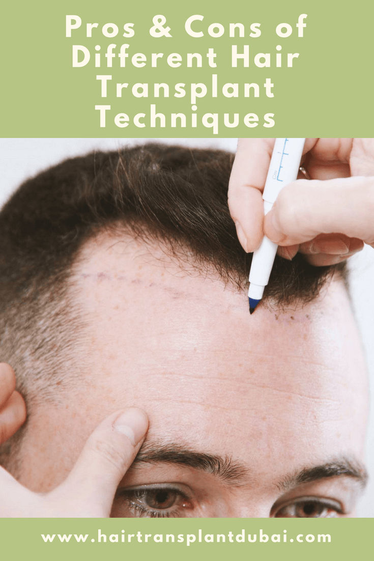 Pros and cons of different hair transplant techniques Hair Transplant Dubai