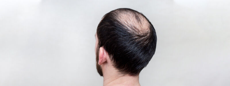 Hair Fillers for Baldness in Dubai, Abu Dhabi & Sharjah