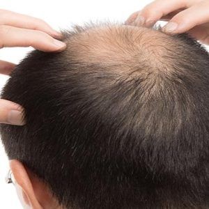 Crown Hair Transplant For thin Scalp in Dubai, Abu Dhabi & Sharjah