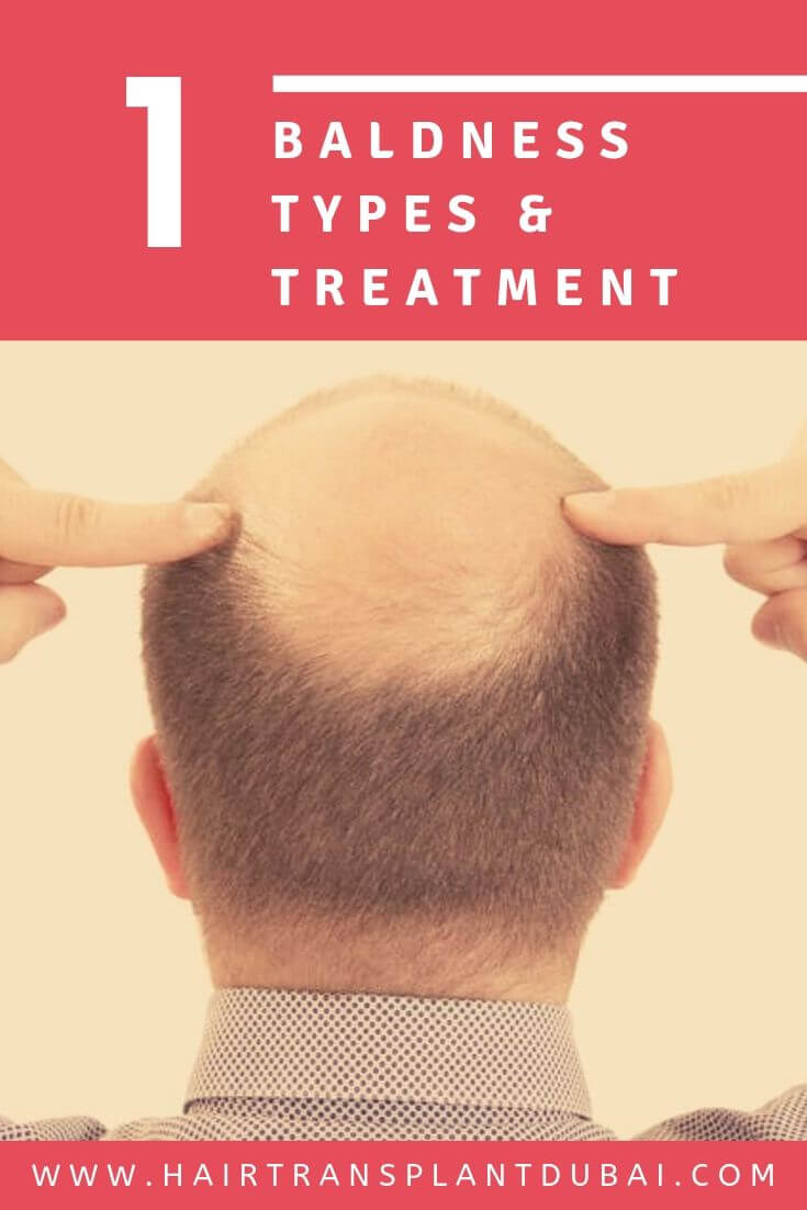 Baldness Types & Treatment in Dubai & Abu Dhabi Hair