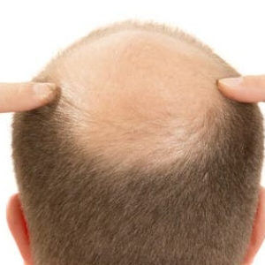 Baldness Types & Treatment in Dubai, Abu Dhabi