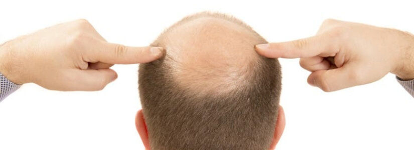 Baldness Types & Treatment in Dubai, Abu Dhabi