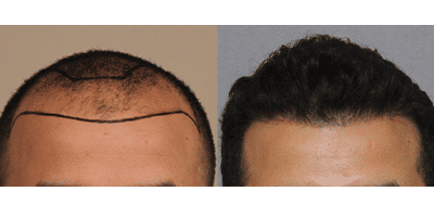 Hair Transplant Before and after