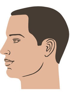 hair transplant before and after
