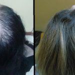 Hair Transplant In Dubai Best Hair Transplant Clinic Dubai Hair Transplant In Dubai Best Hair Transplant Clinic Dubai