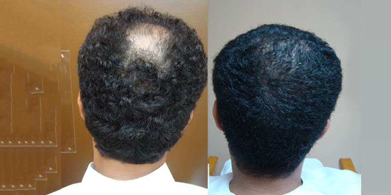 hair transplant before and after